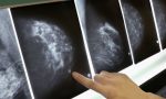 Tumore al seno, l'importanza dell'innovazione: diagnosi e cure migliori e grossi risparmi per il SSN