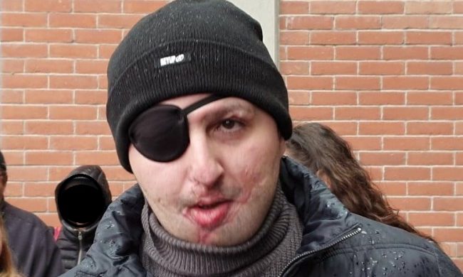 Colpiti dall’acido: a Legnano raccolta fondi per Giuseppe e William