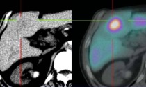Microsfere radioattive per curare i tumori del fegato all'Ospedale di Circolo