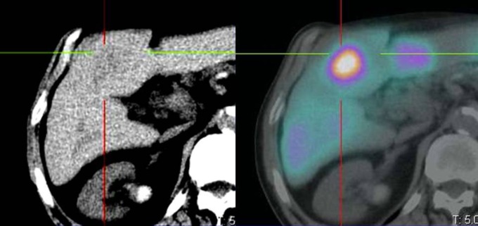 Microsfere radioattive per curare i tumori del fegato all’Ospedale di Circolo