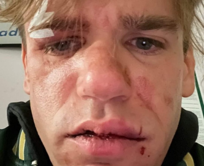 Aggredito e rapinato Jacopo de iPantellas: “Hanno provato a uccidermi”