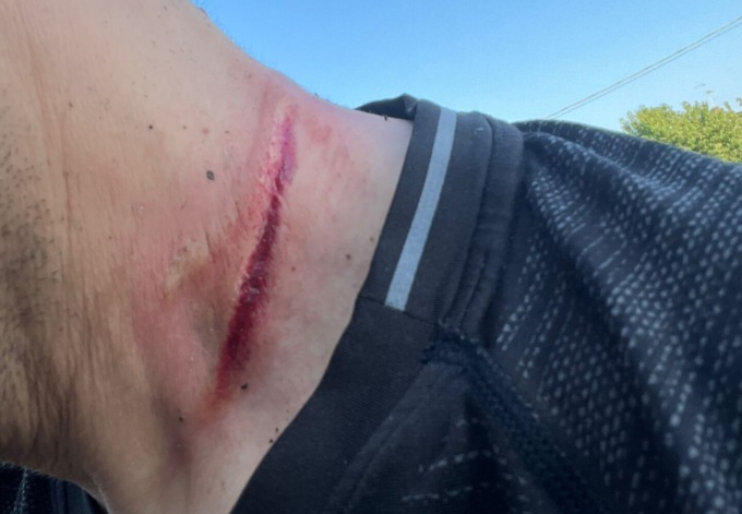 Cavo assassino sul sentiero, motociclista salvo per miracolo